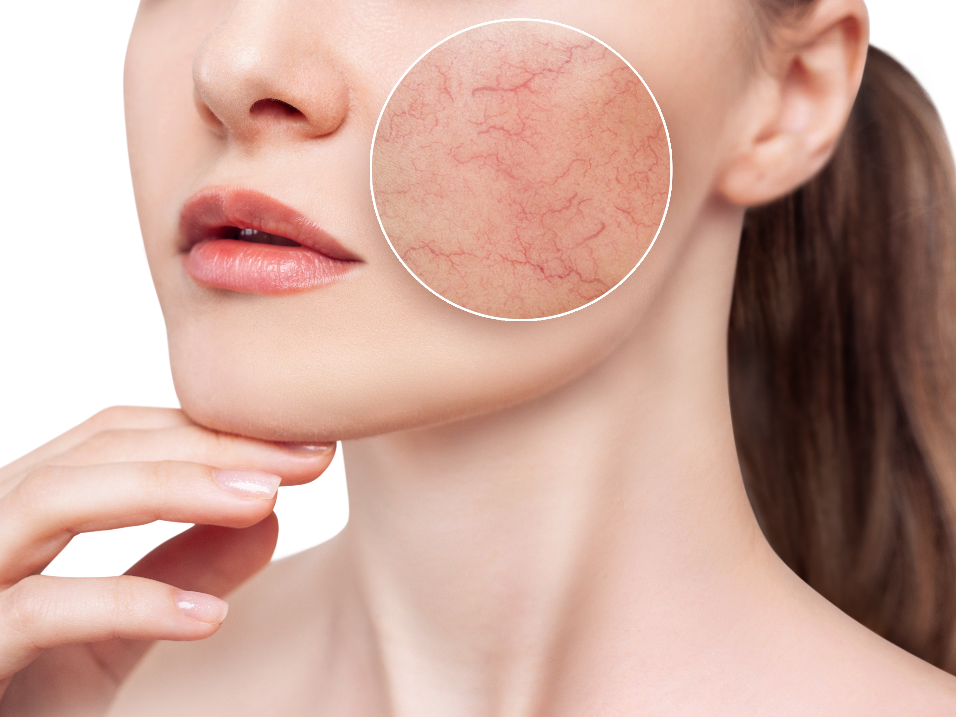 Wenn die Haut rot sieht – Couperose, Rosazea & chronische Rötungen